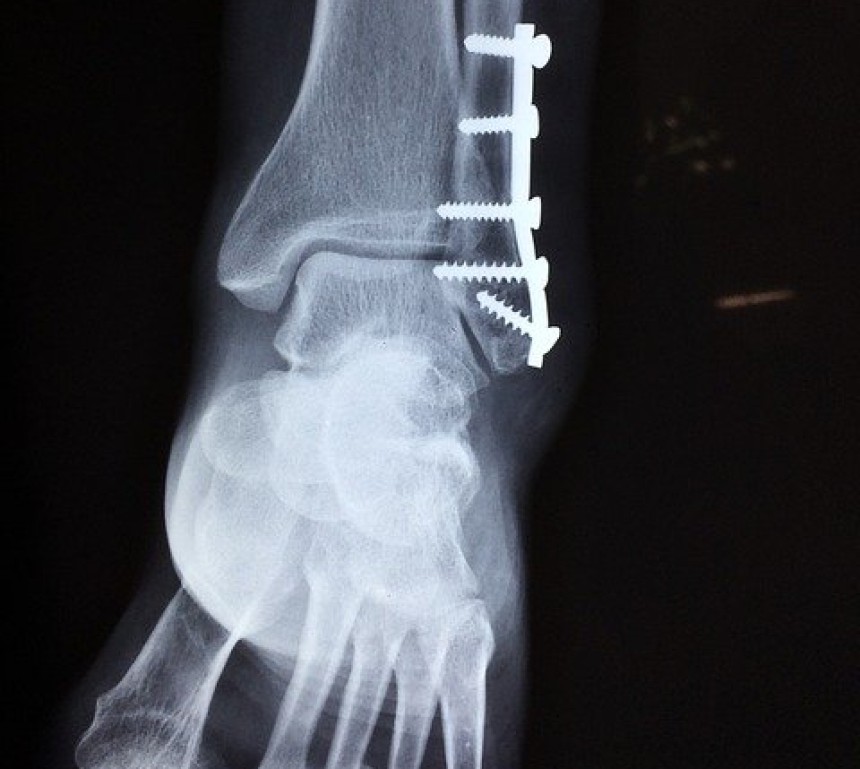 2 years:  officer's leg broken in bar fight